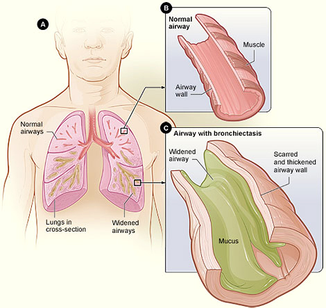 Bronchiectasis Diagram