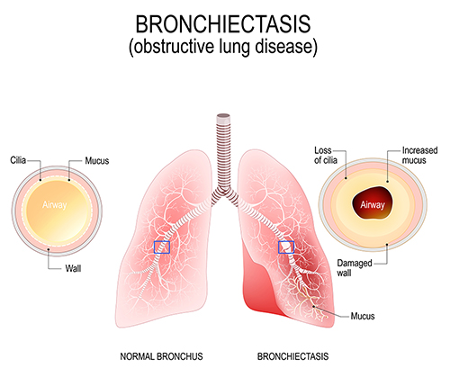 Bronchiectasis Diagram