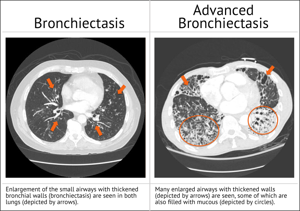 Bronchiectasis CT Scans
